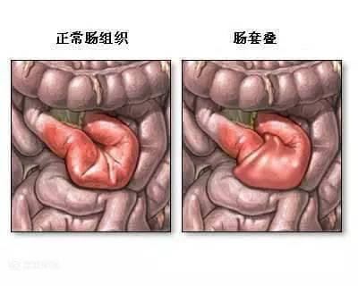 兒童嘔吐是常見癥狀，除了感染因素，家長還要注意這些細節-5