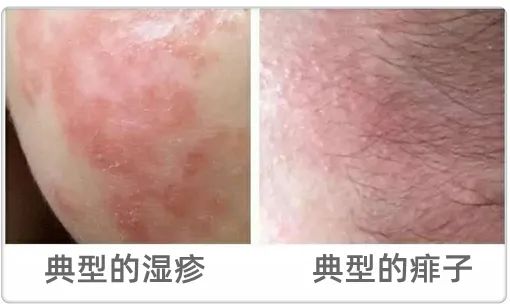爽身粉、花露水不治痱子！ 這種葯才最管用，家門口藥店就有