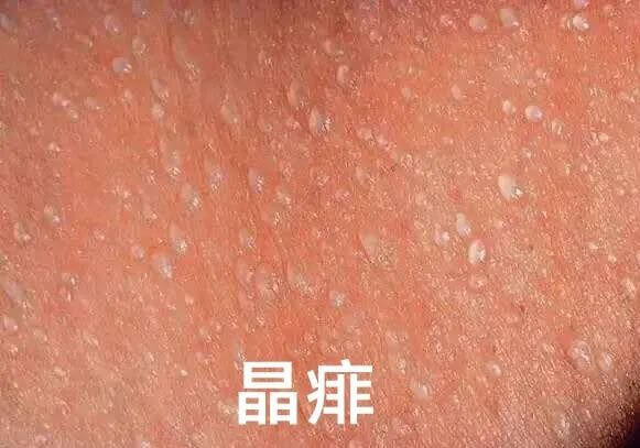 爽身粉、花露水不治痱子！ 這種葯才最管用，家門口藥店就有