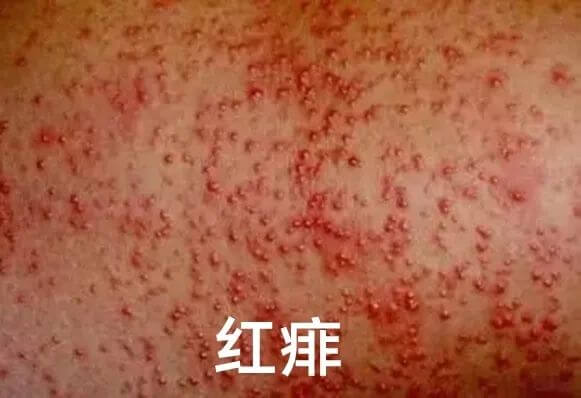 爽身粉、花露水不治痱子！ 這種葯才最管用，家門口藥店就有