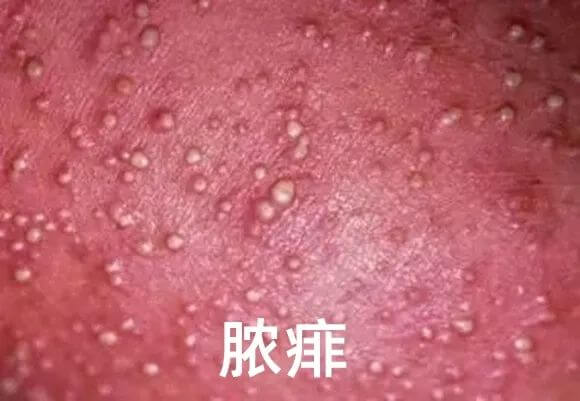 爽身粉、花露水不治痱子！ 這種葯才最管用，家門口藥店就有